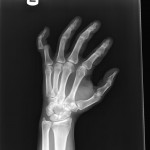 finger dislocation