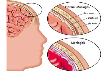 Meningitis Can Cause Death in Hours