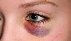 First Aid in Black Eye